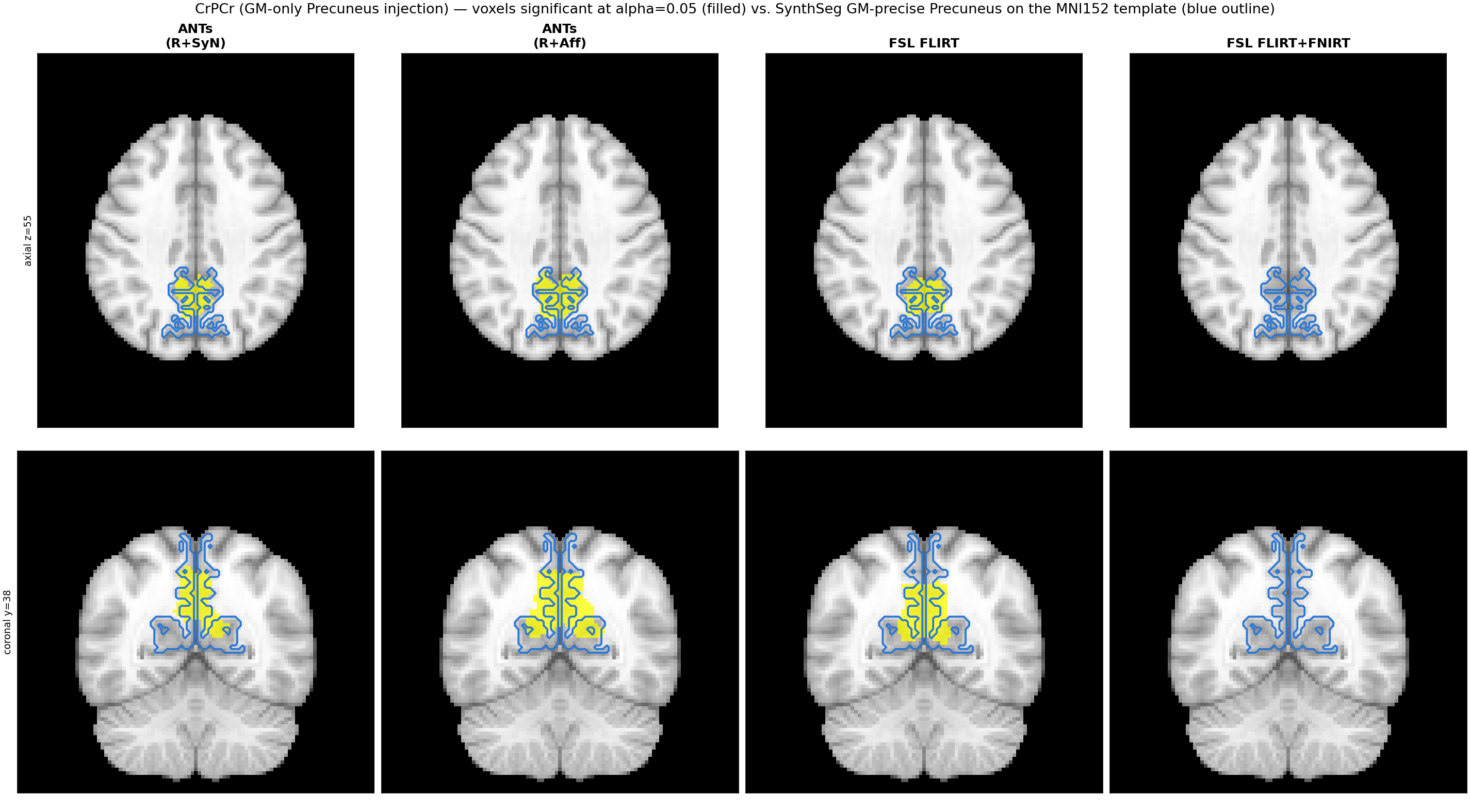 CrPCr (GM-only Precuneus injection): voxels significant at alpha=0.05 (filled) vs. SynthSeg GM-precise Precuneus on the MNI152 template (blue outline), for ANTs (R+SyN), ANTs (R+Aff), FSL FLIRT, and FSL FLIRT+FNIRT