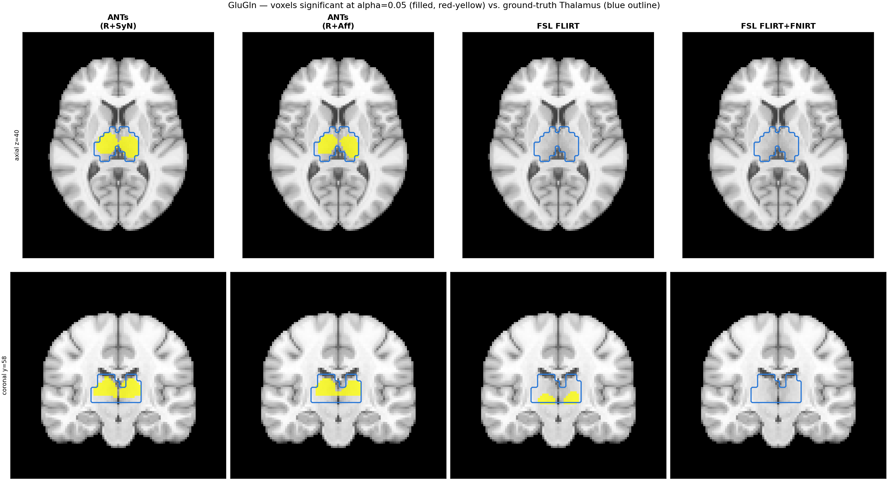 GluGln: voxels significant at alpha=0.05 (filled) vs. ground-truth Thalamus injection mask (outline), for ANTs (R+SyN), ANTs (R+Aff), FSL FLIRT, and FSL FLIRT+FNIRT