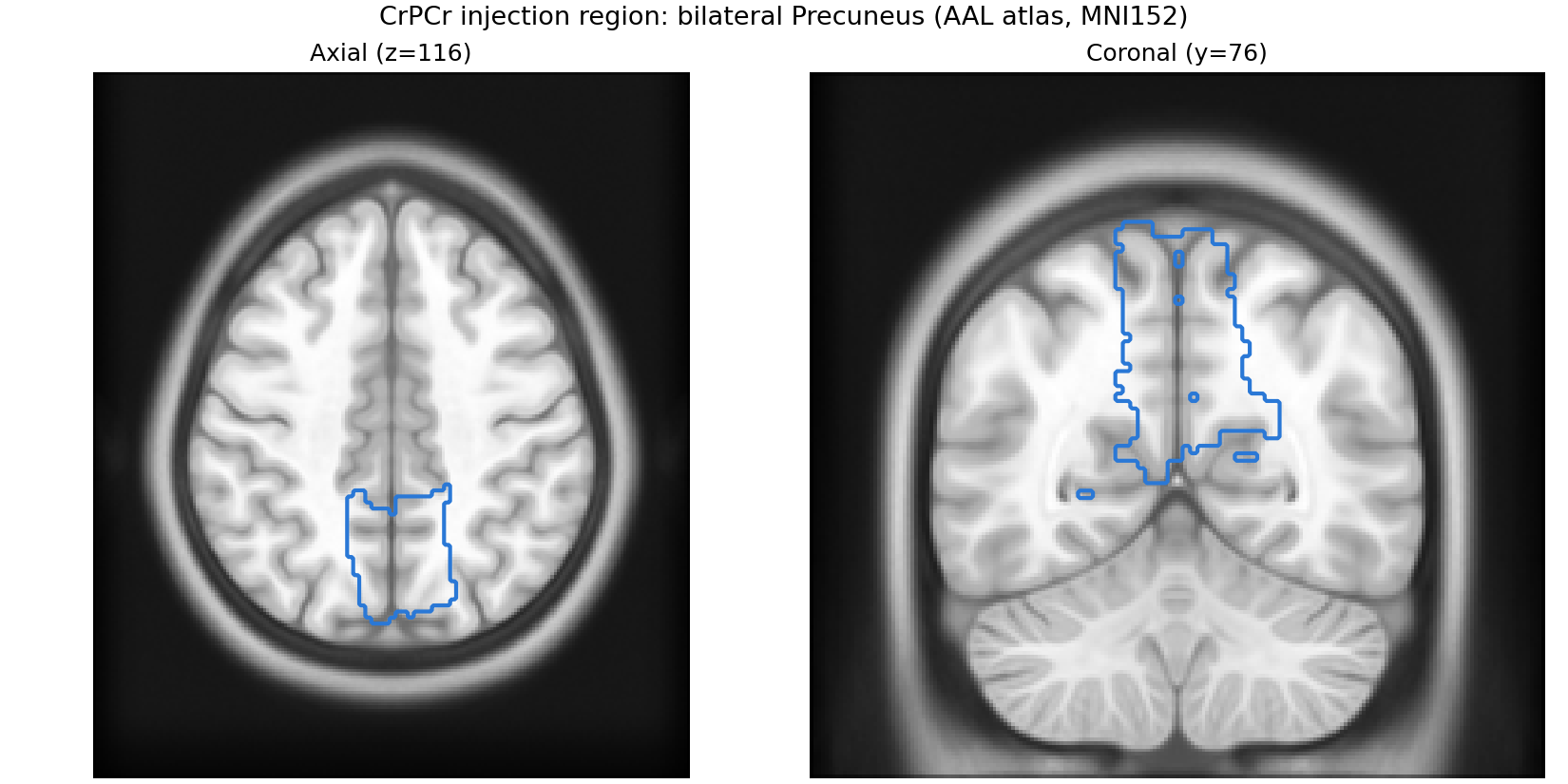 CrPCr injection region, bilateral Precuneus outlined on the MNI152 template from a real AAL atlas parcellation, axial and coronal slices